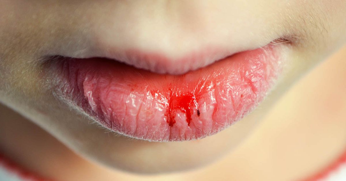 Last van droge lippen? Dit zijn de oorzaken